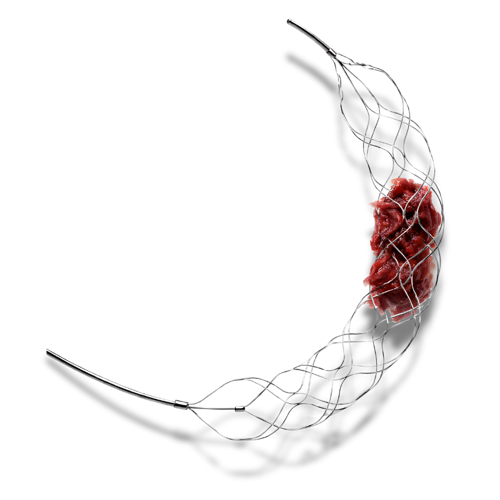 Nitinol stent device